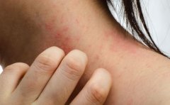 什么是过敏体质